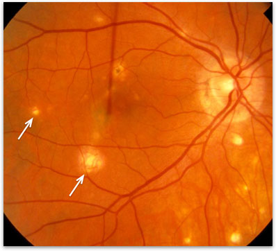 Ocular Histoplasmosis Syndrome Retina Vitreous Surgeons Of Cny