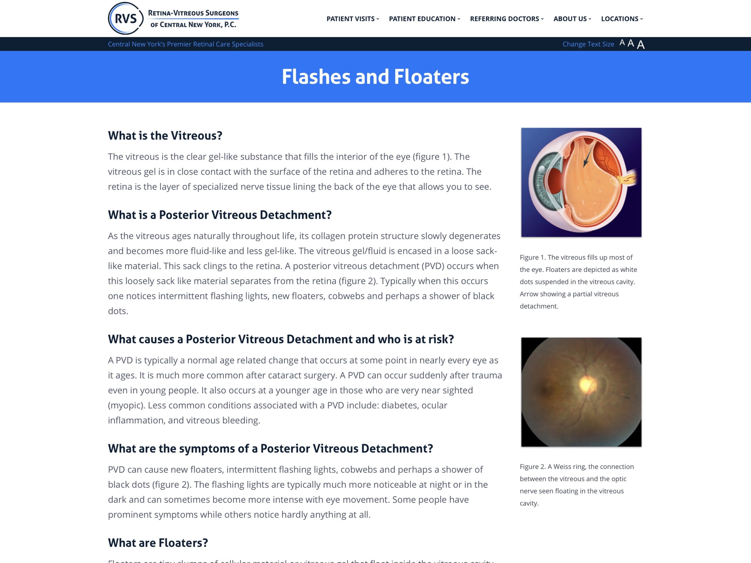 flashes-and-floaters-retina-vitreous-surgeons-of-cny