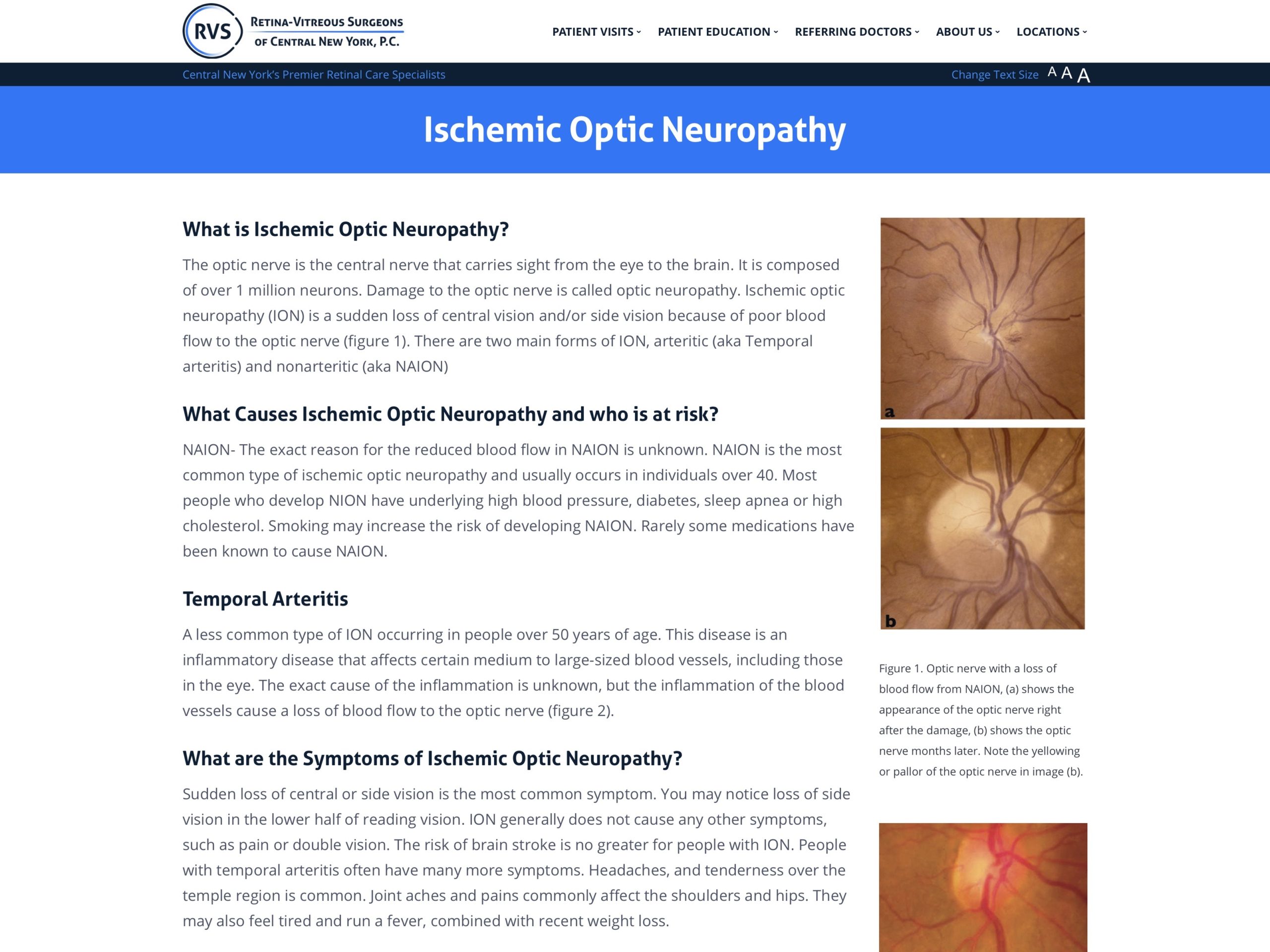 ischemic-optic-neuropathy-retina-vitreous-surgeons-of-cny