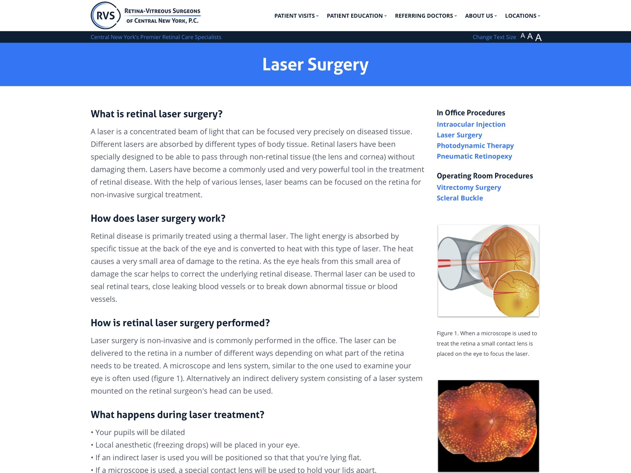 Laser Surgery Retina Vitreous Surgeons Of Cny