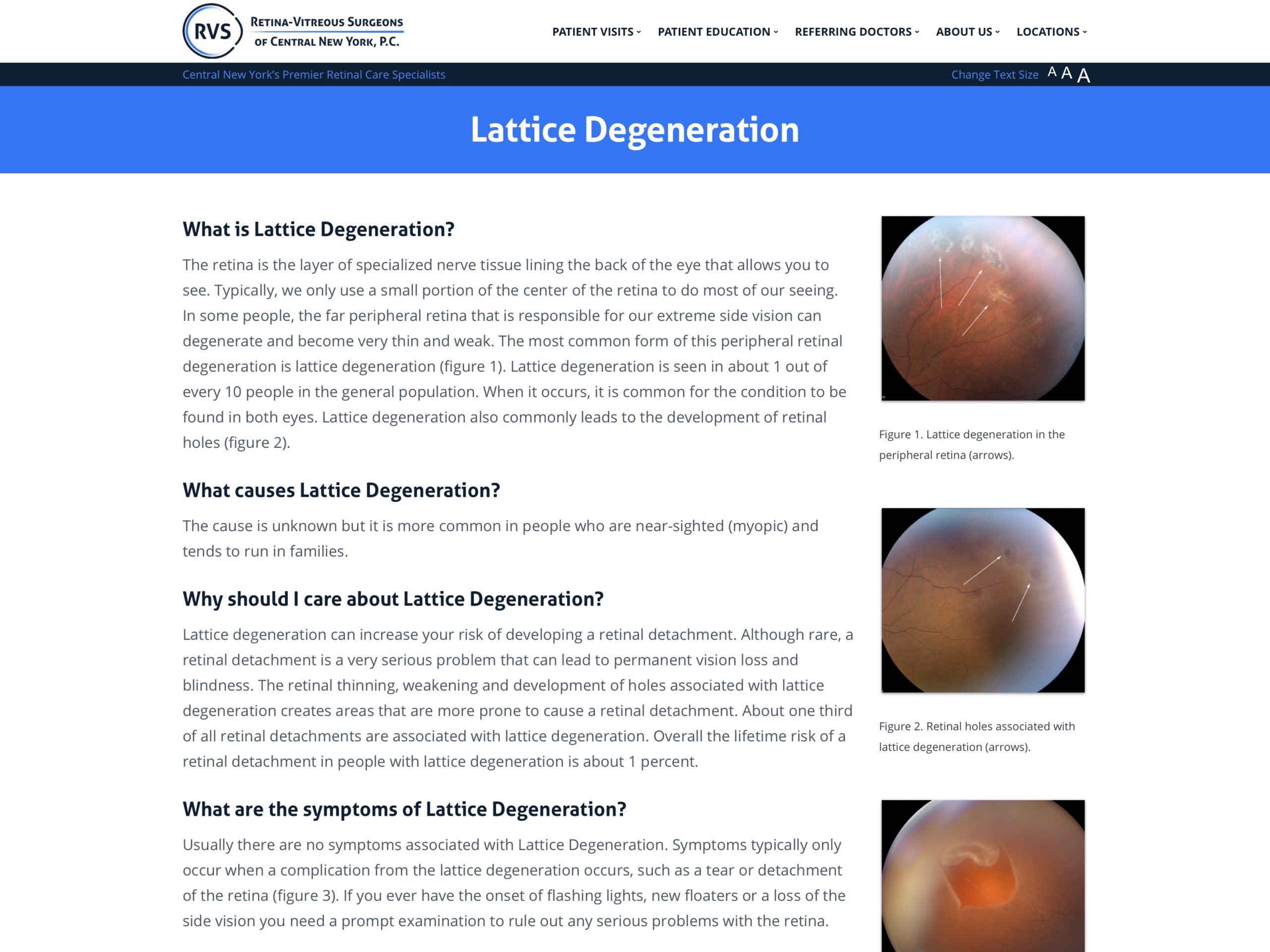 lattice-degeneration-retina-vitreous-surgeons-of-cny