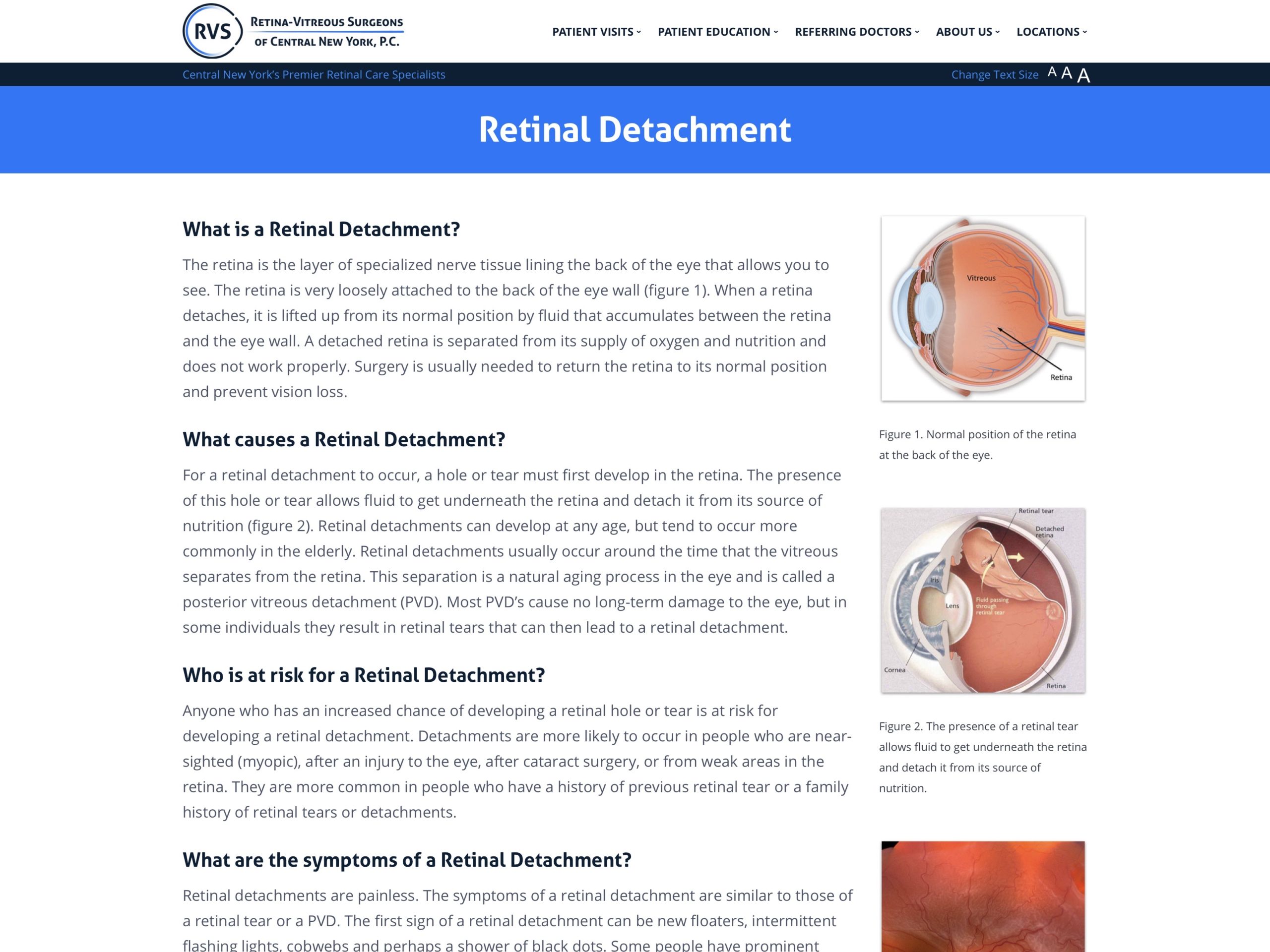 retinal-surgery-laser