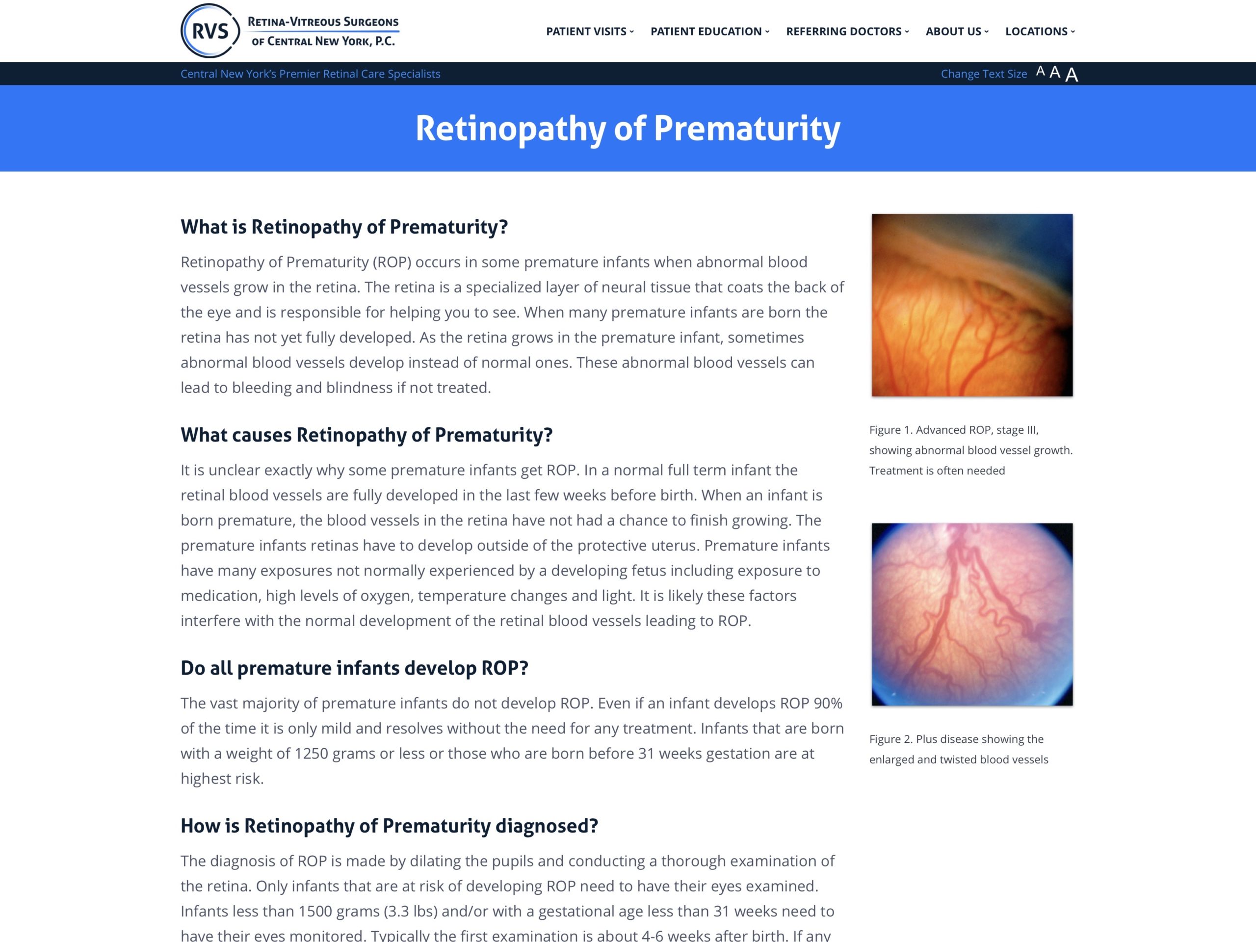 retinopathy-of-prematurity-retina-vitreous-surgeons-of-cny