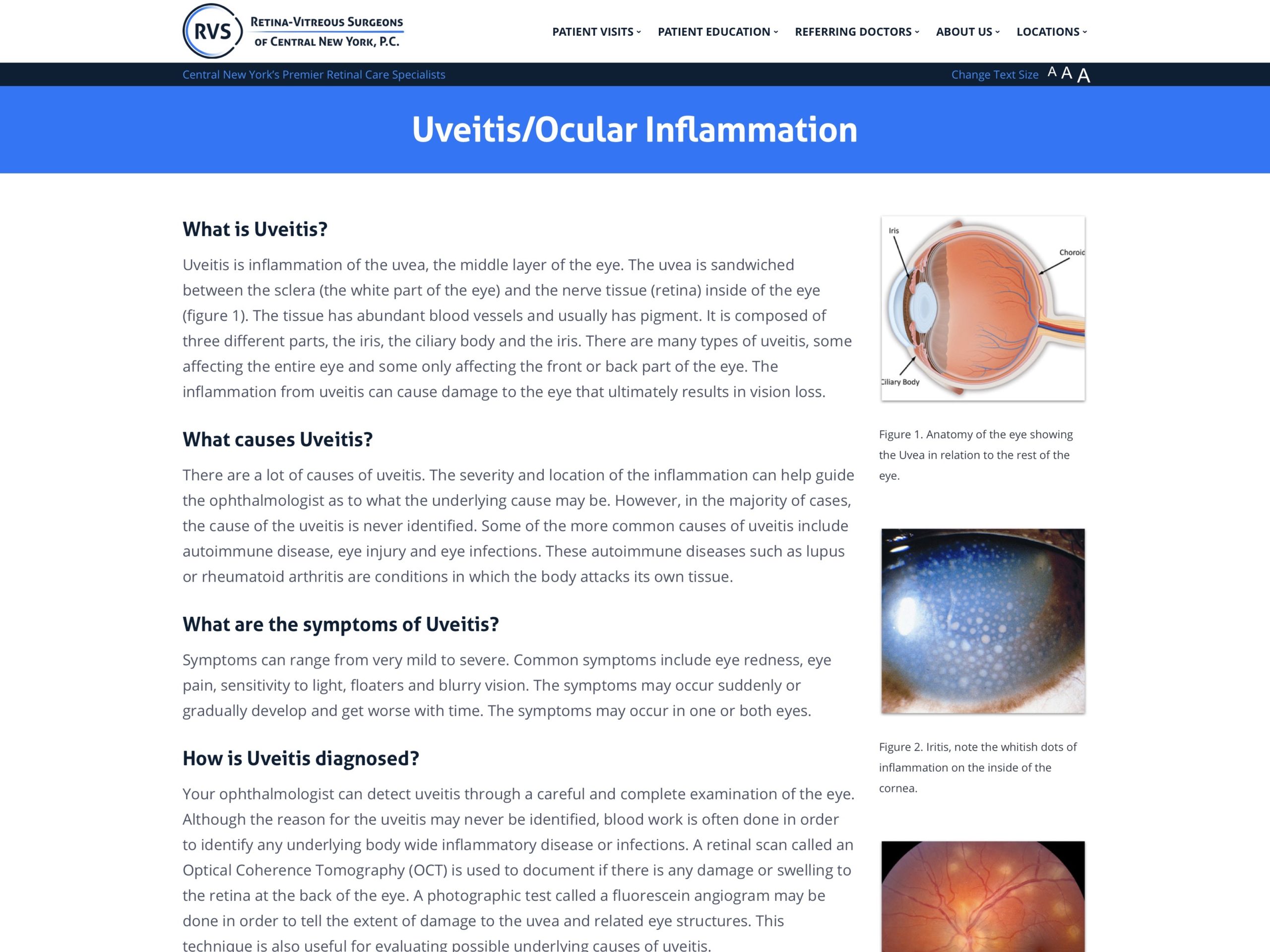 Uveitis / Uveitis | Eye Doctors, Auckland - Choroiditis And Retinitis ...