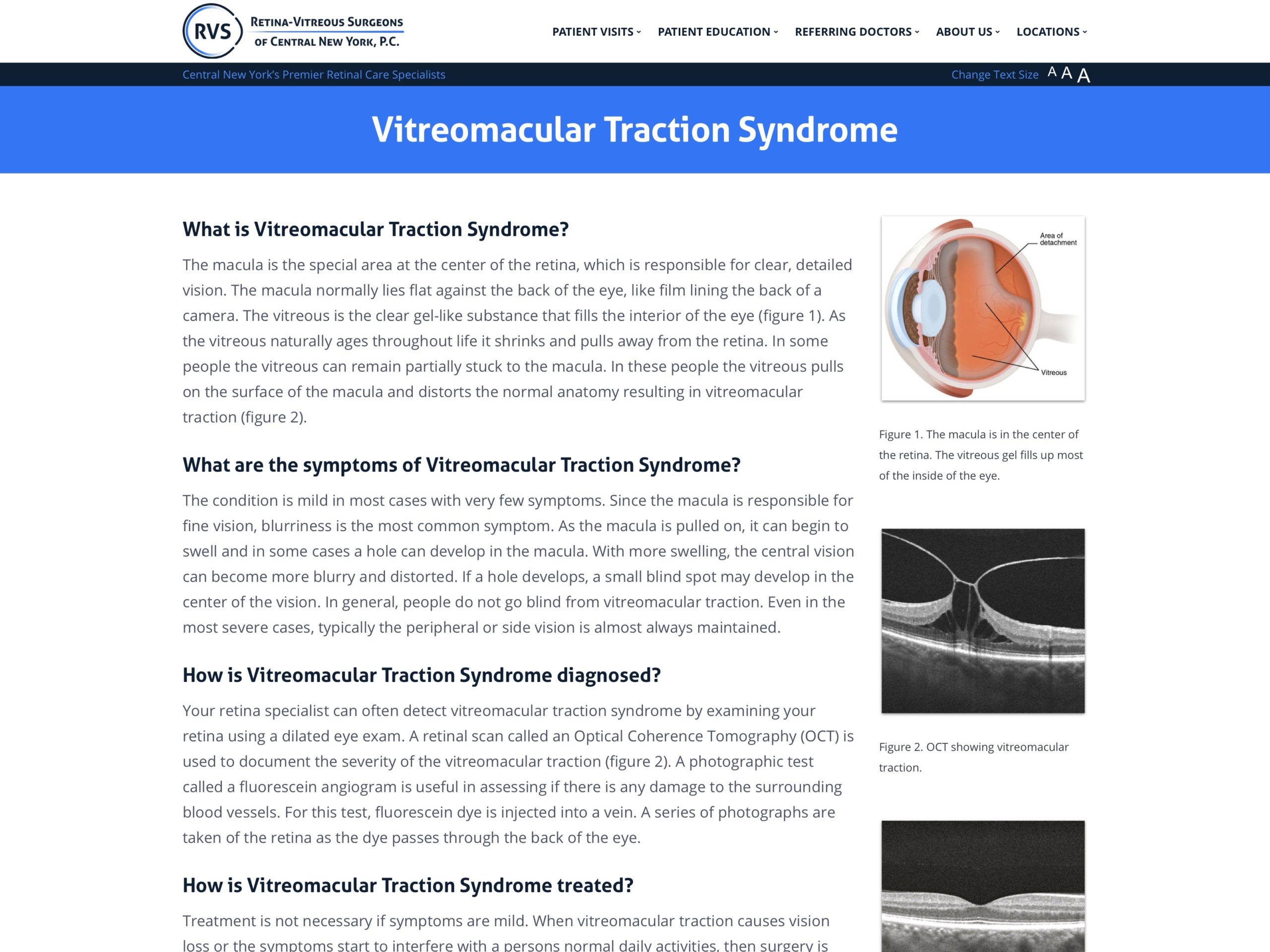 vitreomacular traction oct